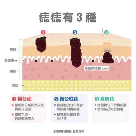 痣 有毛|痣變大、痣多或長毛會變皮膚癌？認識痣的形成與原因